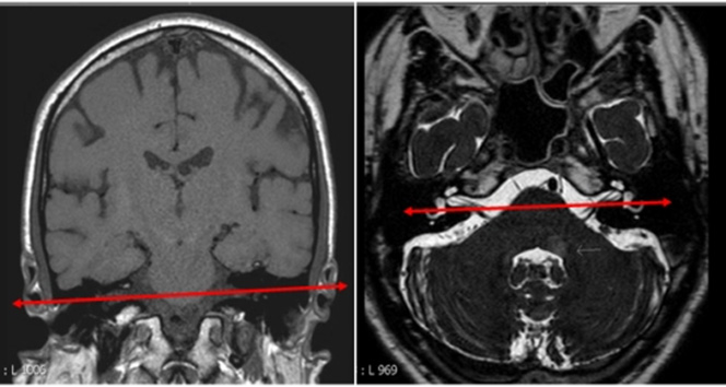 MR IAC WO ENT Protocol | OHSU